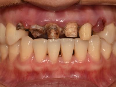 [임플란트] 고난이도 잇몸 뼈이식 사례