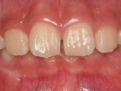 [성장기 교정] 치아 총생